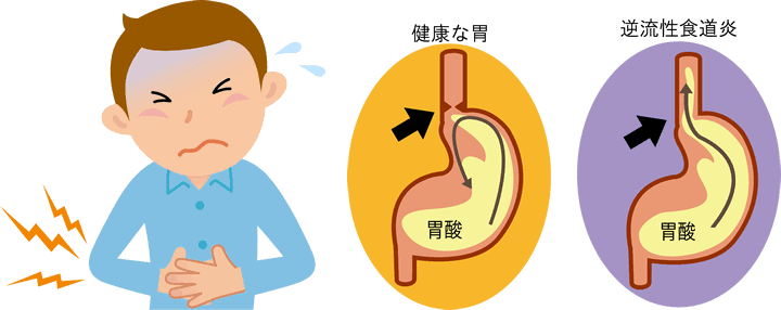 胃食道逆流症と歯の関係