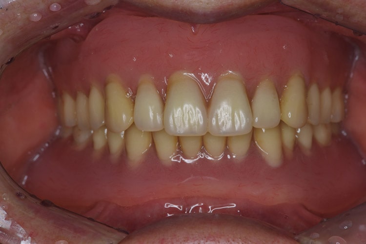 超精密義歯の治療例1