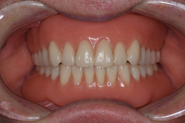 超精密義歯の治療例2