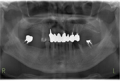 CASE06 治療前