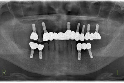 CASE06 治療後